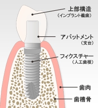 インプラント構造の画像